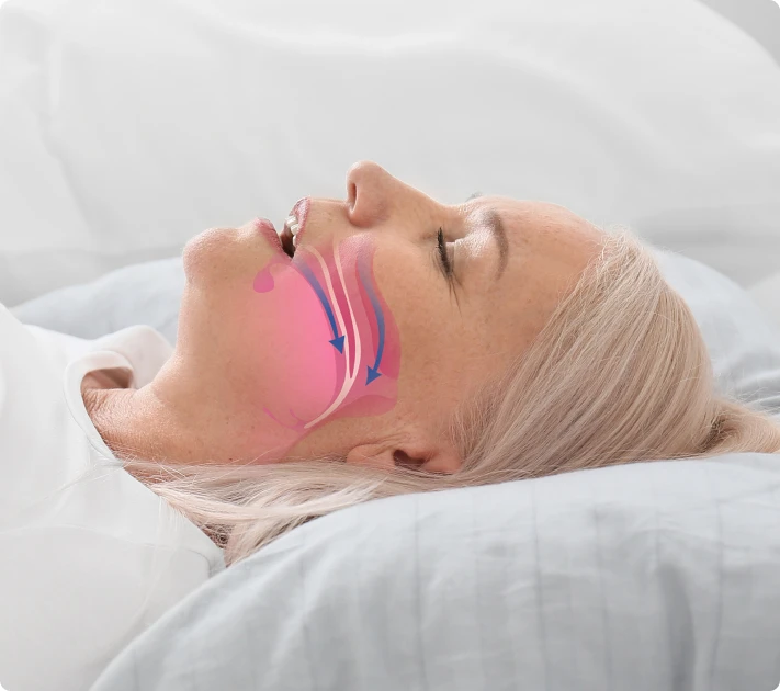 What is Sleep Apnea and Snoring?